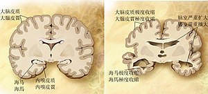 比较正常（左）和阿尔茨海默病（右）患者的脑部