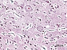 早发性阿尔茨海默病患者的大脑皮质显微影像，组织病理学可见组织内有老年斑块（senile plaques），银染法