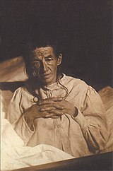 1902年的奥古斯特·迪特，第一位阿尔兹海默症病例